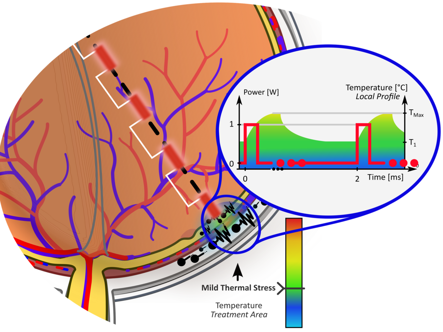 Subthreshold Pulsed Laser (SPL): localised RPE hyperthermia with temperature profile
